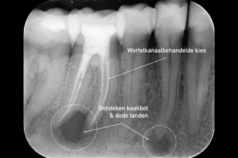 Röntgenbeelden ontsteking avitaal dode tanden wortelkanaalbehandeling MP3 Tandarsten