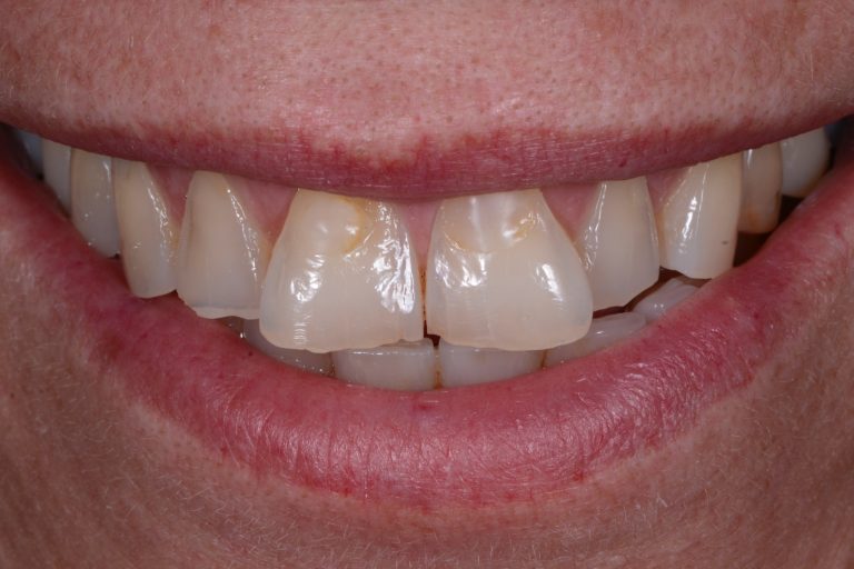 Gebitslijtage Gebitsslijtage Tandslijtage Herstellen van Slijtage Esthetische Tandheelkunde DSD Digital Smile Design Erosie Tanderosie